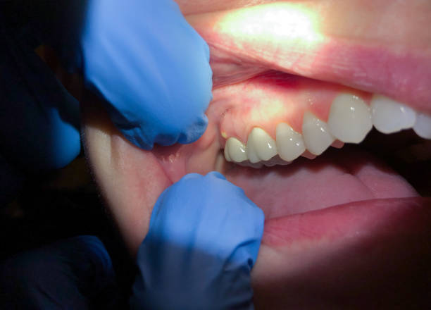 Best Emergency Treatment for Dental Infections or Abscesses in Eustis, FL